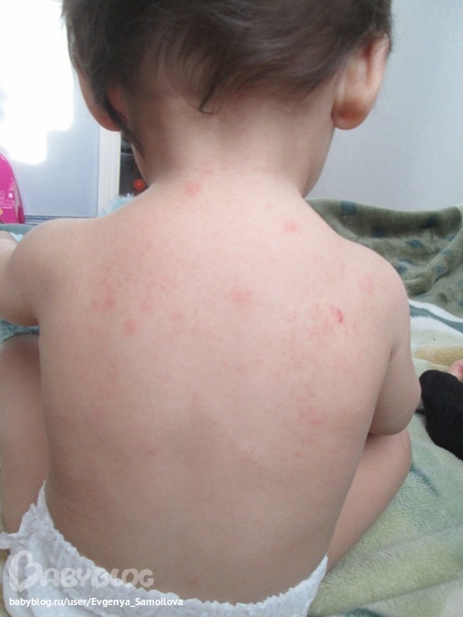 Определяем сыпь по фото - все виды Определяем сыпь по фото - все виды