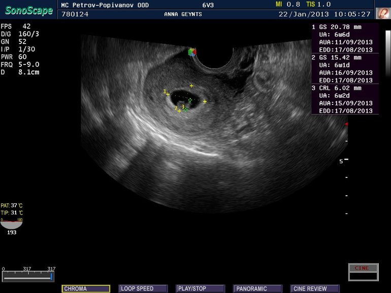7 неделя беременности от зачатия: УЗИ плода, фото живота, что происходит с мамой и малышом