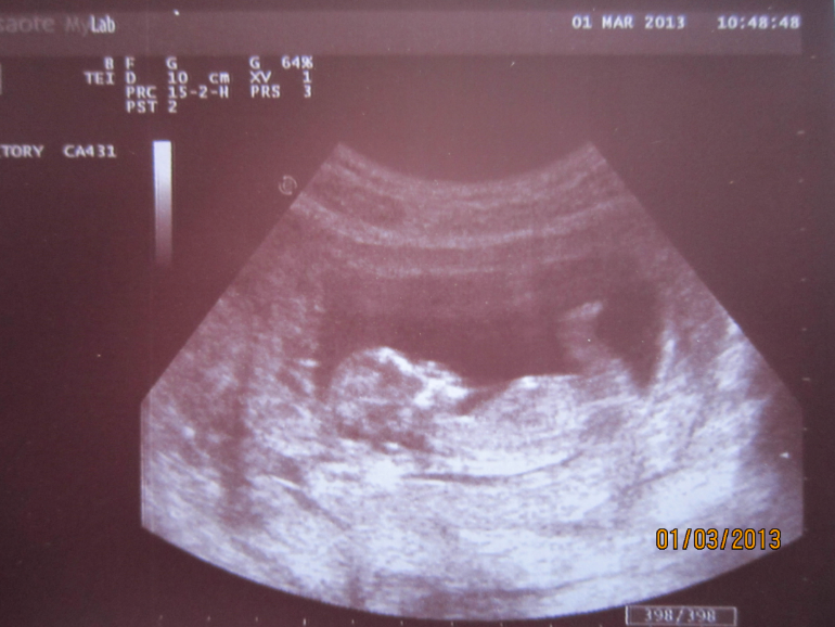 12 недель беременности что есть. 12 Недель беременности фото плода на УЗИ. Снимок УЗИ на 12 неделе беременности. Снимок УЗИ на 12 неделе беременности фото. Ультразвуковое исследование беременности 12 недель.
