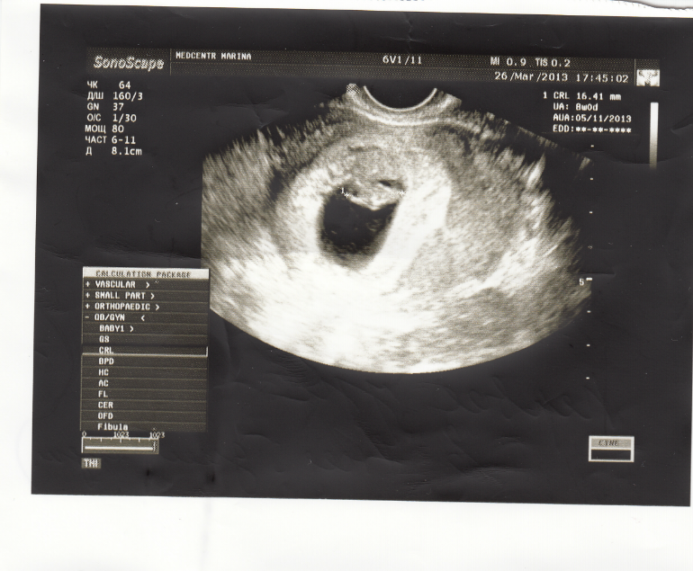 7 неделя беременности акушерская фото узи
