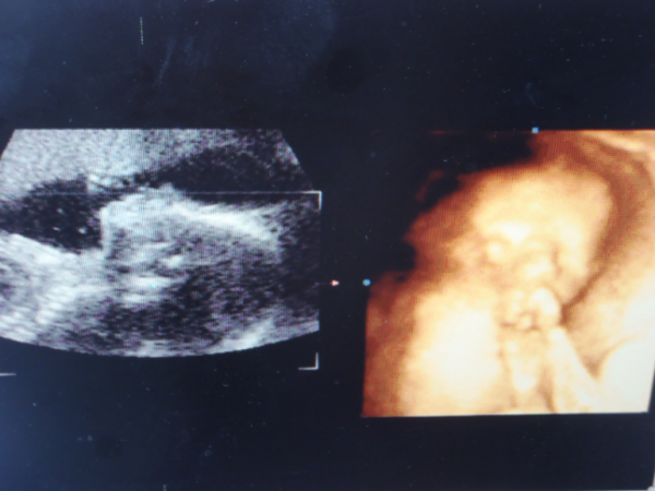 УЗИ 22 недели беременности девочка. Фото УЗИ 22 недели беременности мальчик. УЗИ 22 недели беременности мальчик.