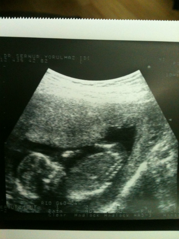 Конец 14 недели. Снимок УЗИ 14 недель беременности. Эмбрион на 14 неделе беременности УЗИ. УЗИ 13 акушерских недель.