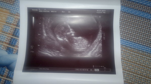 Конец 14 недели. Снимок УЗИ на 3 месяце беременности. На 2 и 3 месяц беременности на УЗИ. Фотография УЗИ беременности 3 месяца. Снимок УЗИ 3 месяца беременности на мониторе.