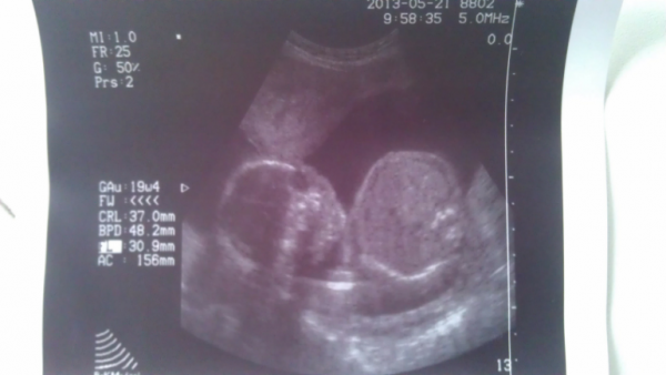 УЗИ 20 недель беременности. Снимки УЗИ на 20 неделе беременности.