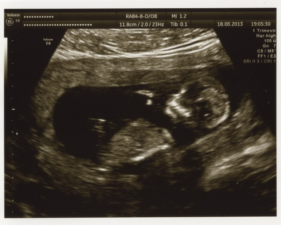 12 недель и 1 день. УЗИ ребенка на 12 неделе беременности. Эмбрион на 12 неделе беременности УЗИ. 12 Недель беременности фото плода на УЗИ. Снимок ребенка на УЗИ 12 недель.