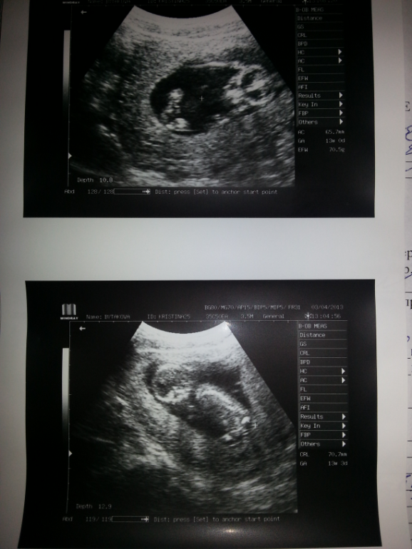 Малыш на 14 неделе. УЗИ снимок плода на 14 неделе. Снимок УЗИ 14 недель беременности. Ребёнок 14 недель беременности мальчик УЗИ. УЗИ 14 недель беременности фото.