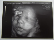 Фото УЗИ на 36 неделе беременности