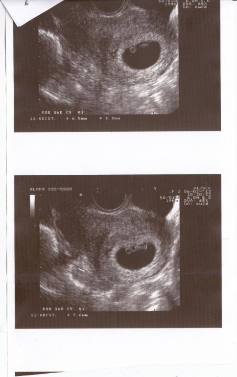 Как выглядит узи на 6 неделе. Снимок УЗИ беременности 5-6 недель. 6 Недель 5 дней беременности УЗИ. Снимки УЗИ на 6 неделе беременности. Снимок УЗИ на 6 неделе беременности.