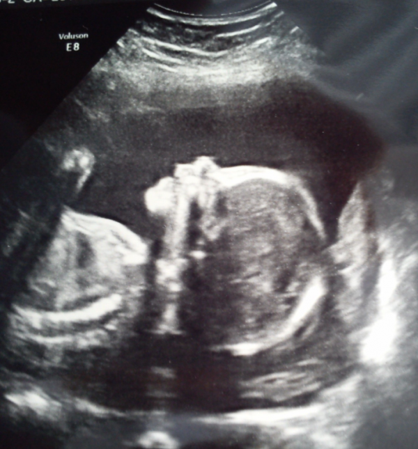 23 неделя отзывы. УЗИ 23 недели беременности девочка. Снимок УЗИ 23 недели беременности девочка.
