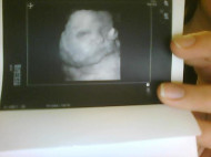 Фото УЗИ на 32 неделе беременности