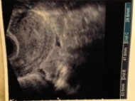 Фото УЗИ на 3 неделе беременности