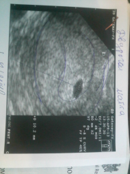 Фото УЗИ на 3 неделе беременности