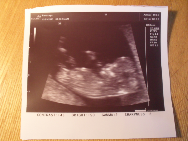 Снимок УЗИ на 12 неделе беременности. Фото УЗИ беременности 3-4 месяца. Снимки УЗИ 3 месяц беременности. Снимок ребенка на 3 месяце беременности.