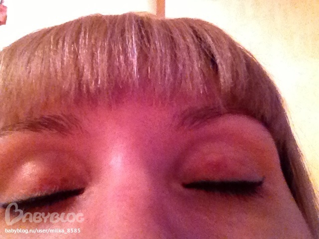 Верхнее веко день пятый