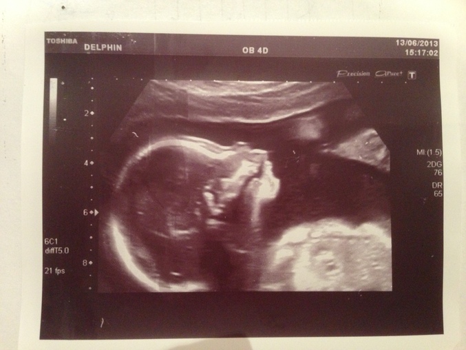 В 20 недель голова. Снимки УЗИ на 20 неделе беременности. Голова на УЗИ беременности 20 недель. УЗИ девочки на 20 неделе беременности. УЗИ 20 недель беременности фото.