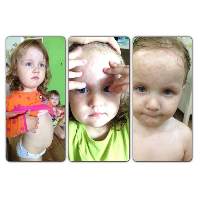 Ветрянка, наш опыт.