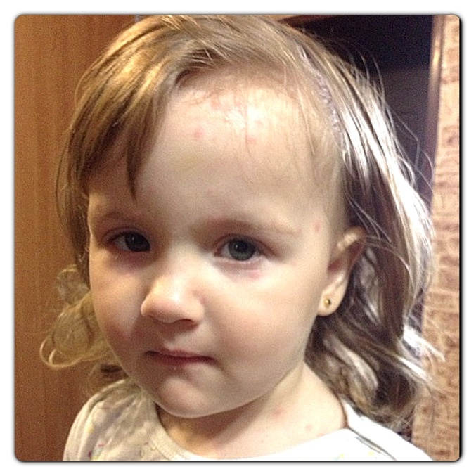 Ветрянка, наш опыт.