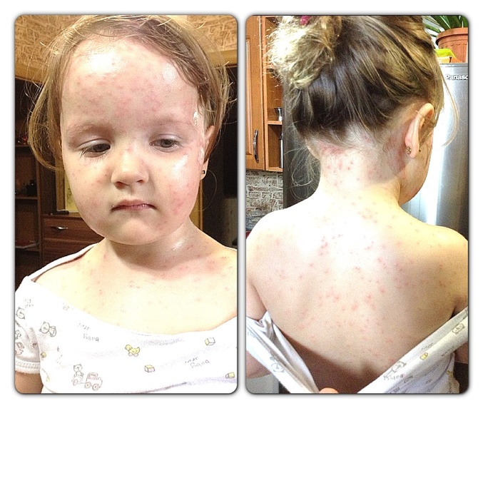 Ветрянка, наш опыт.