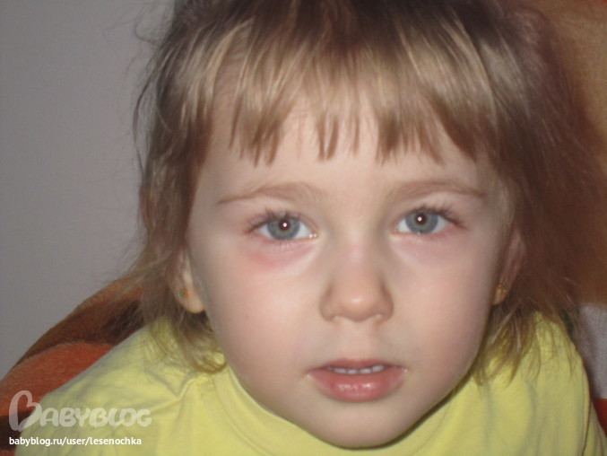 Красные пятна под глазами (вокруг глаз) - причины и лечение