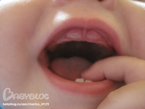 Как вылечить спайки на яичниках
