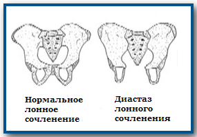 Где находится лонное сочленение у женщин фото при беременности