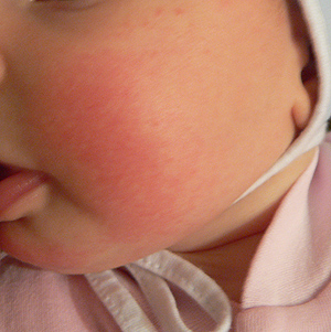 От зефира может быть аллергия у ребенка thumbnail