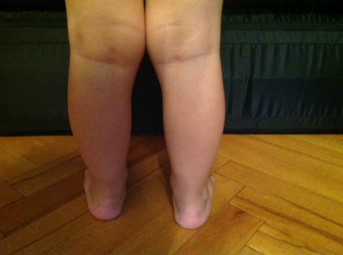 Ноги иксом исправить можно у ребенка?