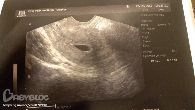 Эндометрий 1 мм. УЗИ матки перед месячными. Снимок УЗИ перед месячными. УЗИ беременности до месячных. Снимок матки на УЗИ перед месячными.