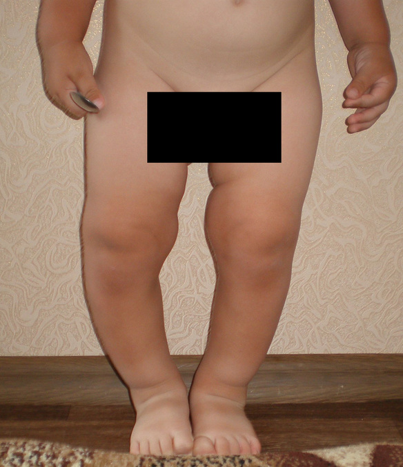 Нога ребенка 1.5 года
