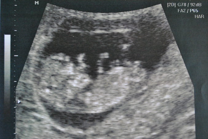 Сколько будет 11 недель. УЗИ на 11 неделе беременности скрининг. Фото УЗИ на 11 неделе беременности скрининг. Снимок УЗИ 11 недель. УЗИ 11 недель беременности.
