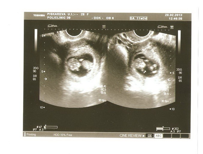 Узи 10 недель беременности фото форум