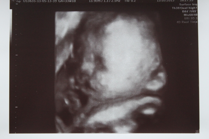 10 11 недель беременности фото плода на узи