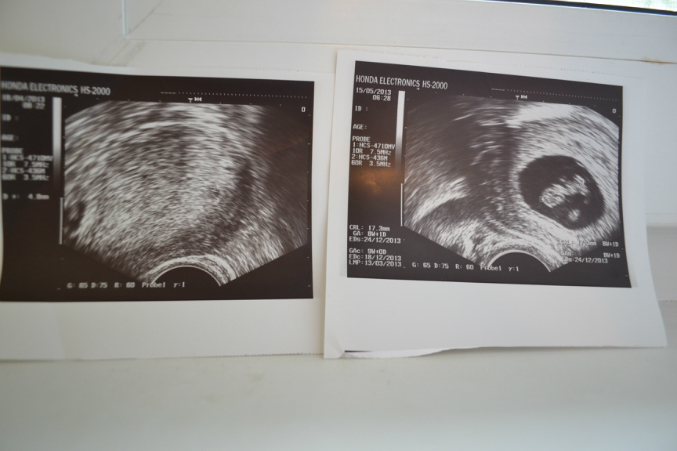 Забеременела в 8. Прогрессирующая беременность 7 недель.